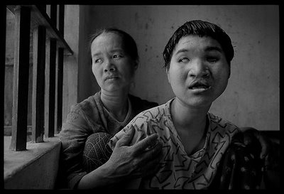 A Vietnamese Girl affected by Agent Orange