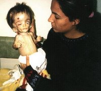 Defromed Iraqi Baby due to Depleted Uranium